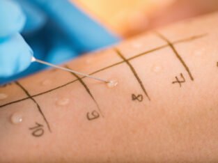 Skin Allergy Testing Near Me Texas – Complete Family Wellness