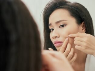 Best ayurvedic cream to remove pimple marks | ayurvidha