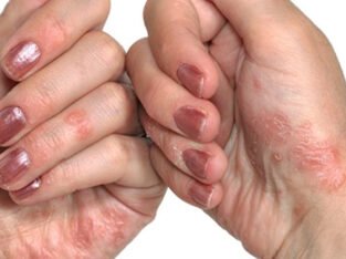 Ayurvedic cream for psoriasis | ayurvidha