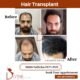 What are the Donor Zones in Hair Transplant Surgery?