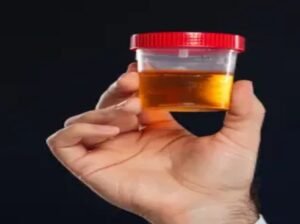 Hematuria Guide: Diagnosis and Treatment of Blood in Urine