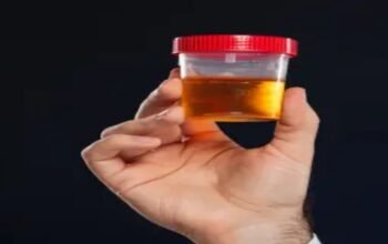 Hematuria Guide: Diagnosis and Treatment of Blood in Urine