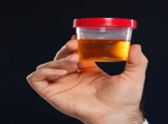 Hematuria Guide: Diagnosis and Treatment of Blood in Urine