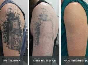 Safe & Effective Tattoo Removal in Calabasas for Clear, Renewed Skin