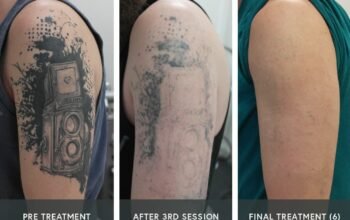 Safe & Effective Tattoo Removal in Calabasas for Clear, Renewed Skin