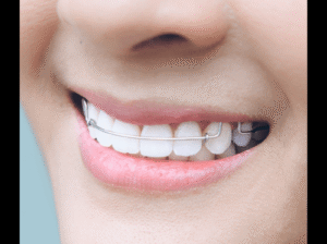 One Dentall – Clear Aligner Treatment